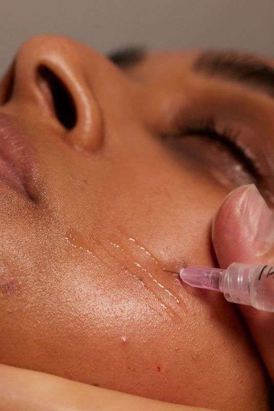 Imagem de bioestimuladores de colágeno